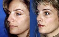 galeria Female Nose Breaker