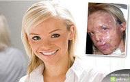 Katie Piper - przez dwadzieścia trzy godziny nosi na twarzy plastikową maskę medyczną
