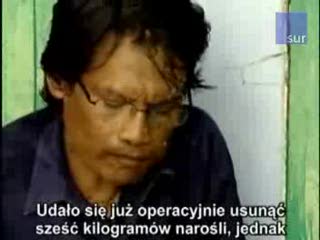 Człowiek-drzewo rozpoczął leczenie
