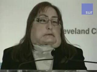 Życie po przeszczepie twarzy
